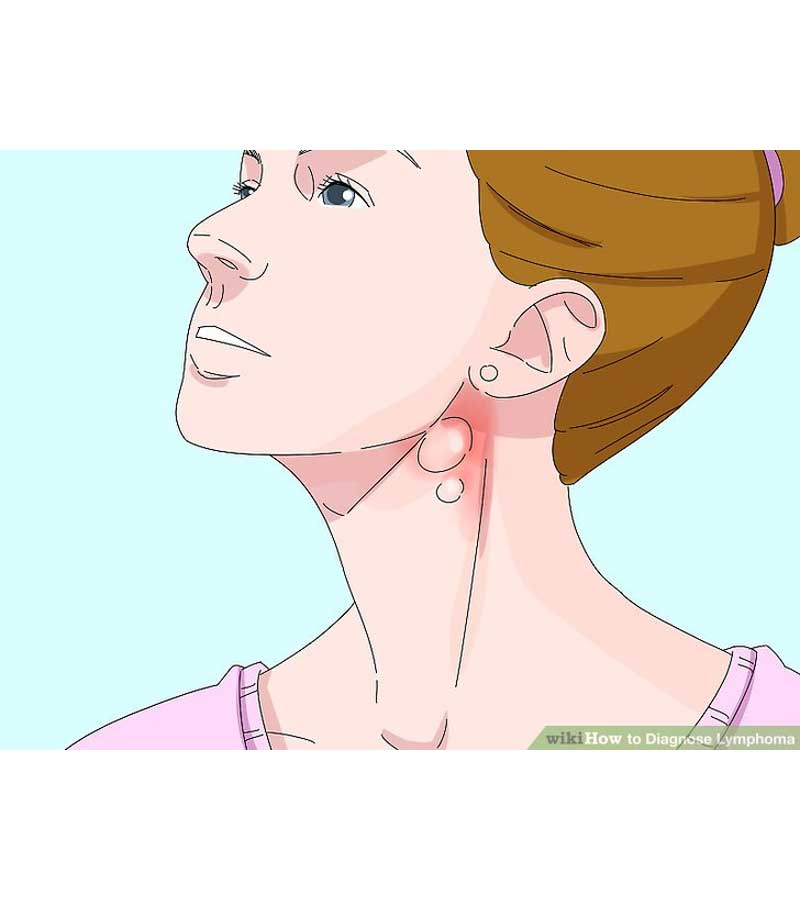 U Lympho không Hodgkin là gì?