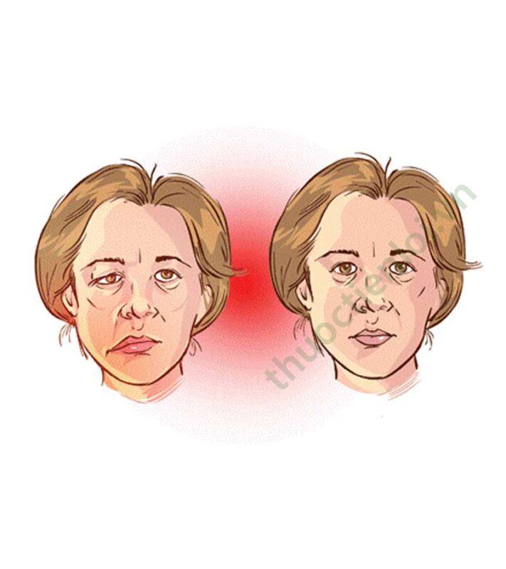 Nhận biết và điều trị bệnh nhược cơ