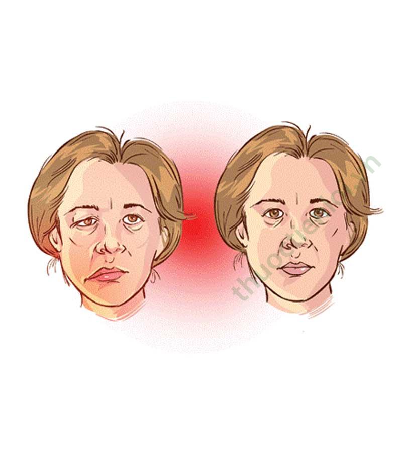 Nhận biết và điều trị bệnh nhược cơ