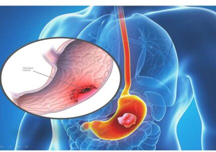Bệnh ung thư dạ dày là gì?