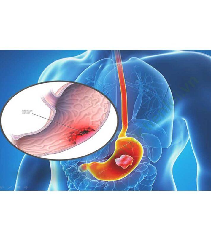 Bệnh ung thư dạ dày là gì?